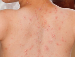 Dinkes Boalemo Pastikan Nol Kematian Campak, Imunisasi Jadi Kunci Perlindungan Anak