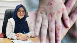 Kadis Kesehatan Boalemo Imbau Warga Waspada Campak Jelang Lebaran