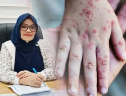 Kadis Kesehatan Boalemo Imbau Warga Waspada Campak Jelang Lebaran